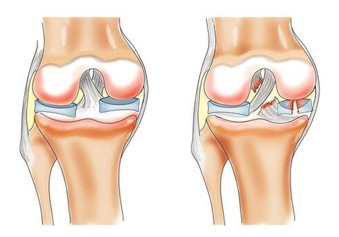 osteoarthritis of the healthy knee and knee joint